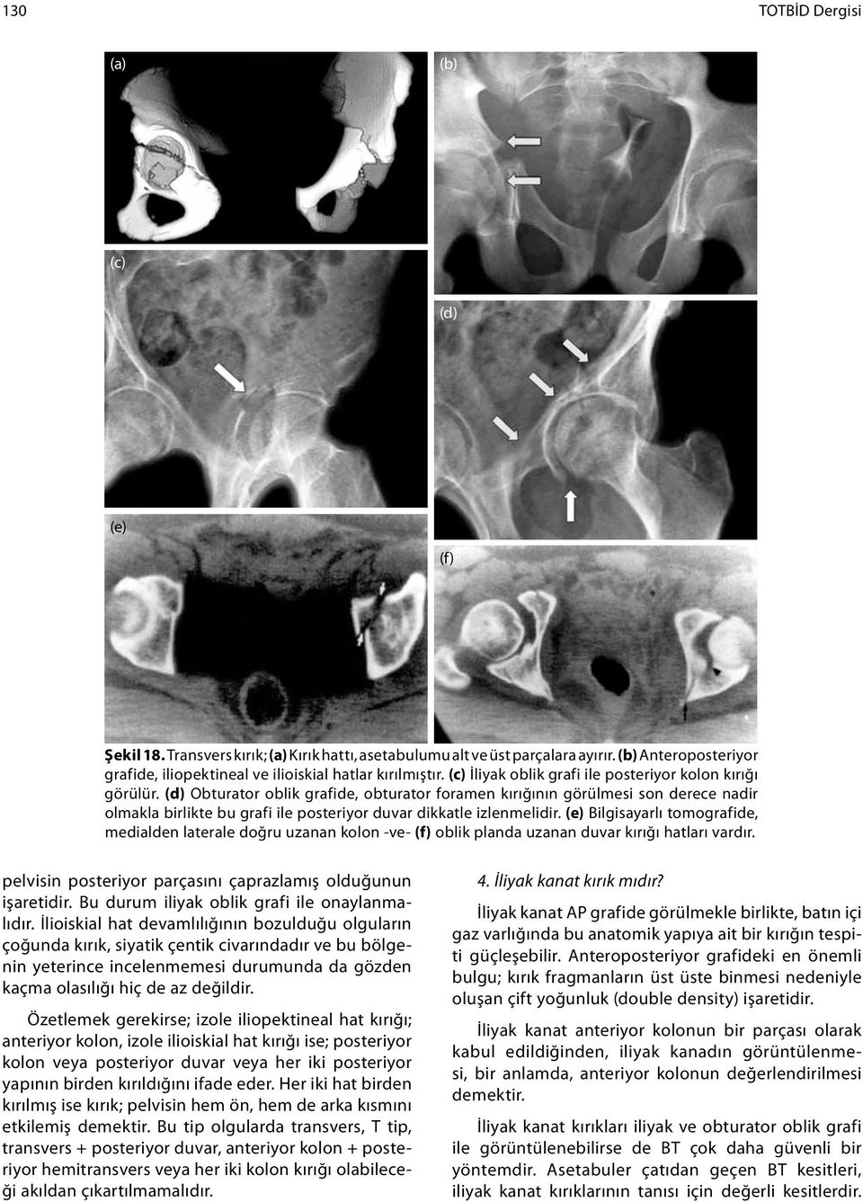 (d) Obturator oblik grafide, obturator foramen kırığının görülmesi son derece nadir olmakla birlikte bu grafi ile posteriyor duvar dikkatle izlenmelidir.