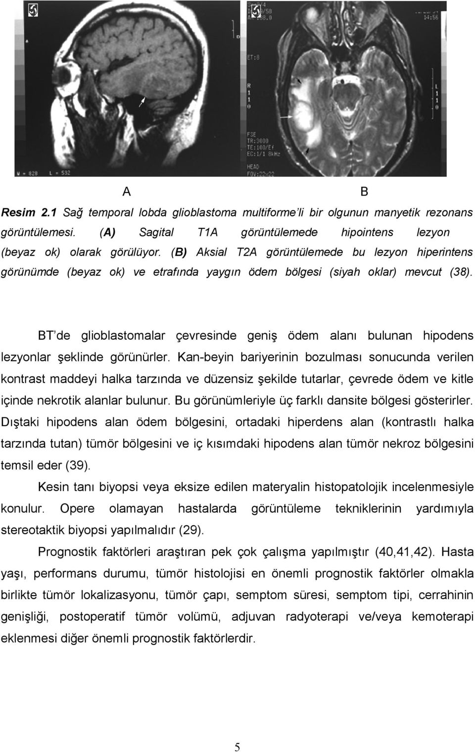 BT de glioblastomalar çevresinde geniş ödem alanı bulunan hipodens lezyonlar şeklinde görünürler.