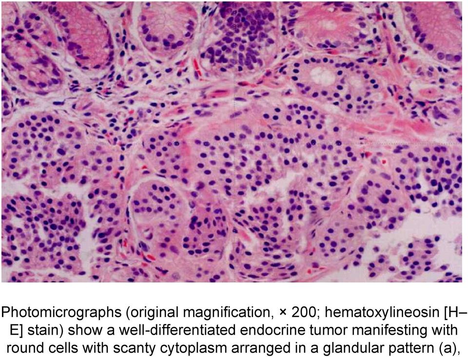 well-differentiated endocrine tumor manifesting
