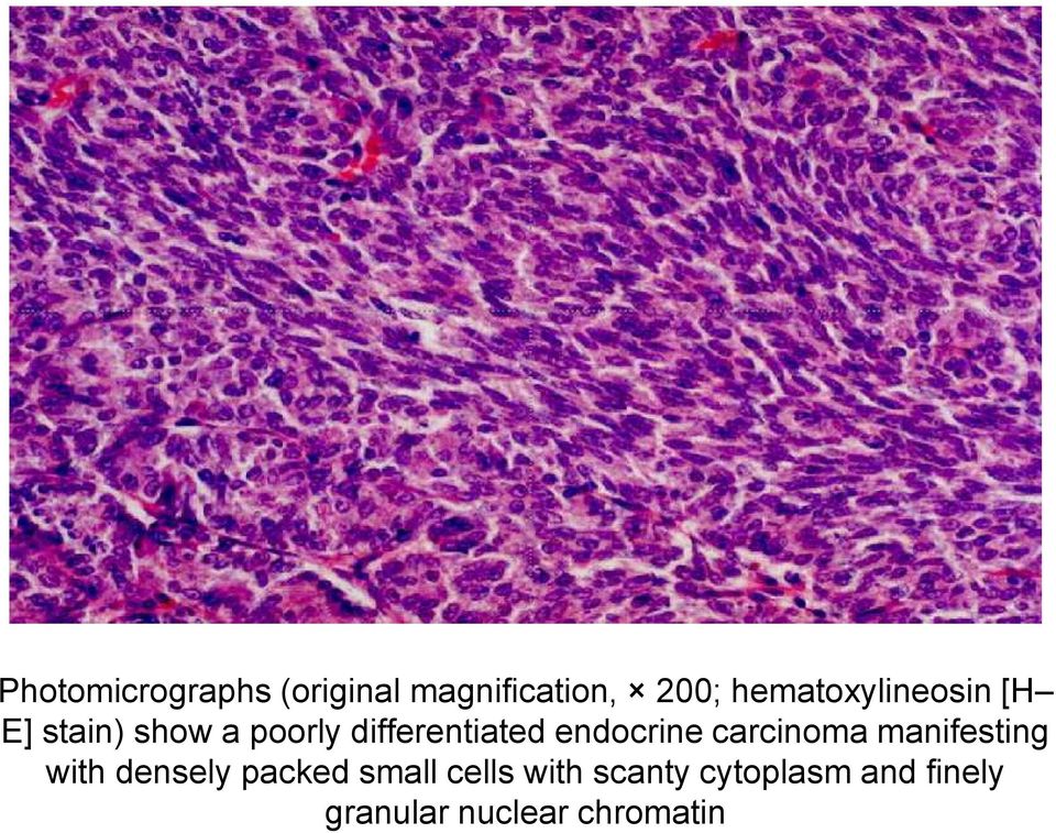 differentiated endocrine carcinoma manifesting with