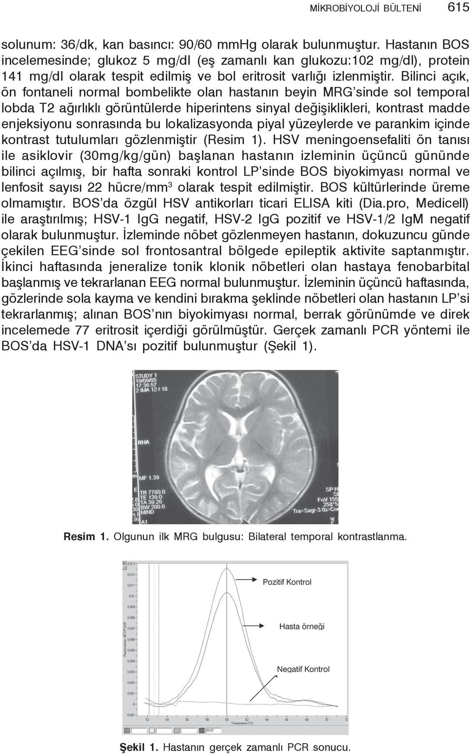 Bilinci açık, ön fontaneli normal bombelikte olan hastanın beyin MRG sinde sol temporal lobda T2 ağırlıklı görüntülerde hiperintens sinyal değişiklikleri, kontrast madde enjeksiyonu sonrasında bu