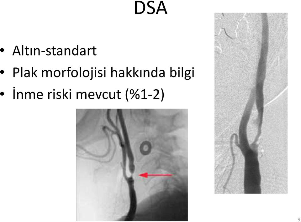 hakkında bilgi İnme