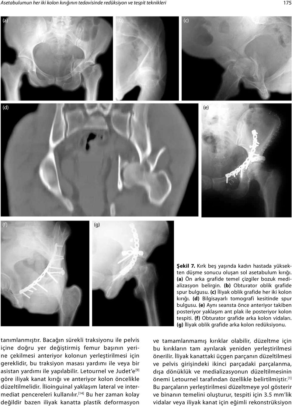 (c) İliyak oblik grafide her iki kolon kırığı. (d) Bilgisayarlı tomografi kesitinde spur bulgusu. (e) Aynı seansta önce anteriyor takiben posteriyor yaklaşım ant plak ile posteriyor kolon tespiti.