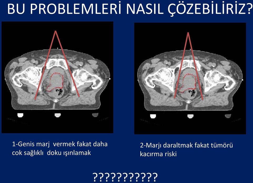 sağlıklı doku ışınlamak 2-Marjı