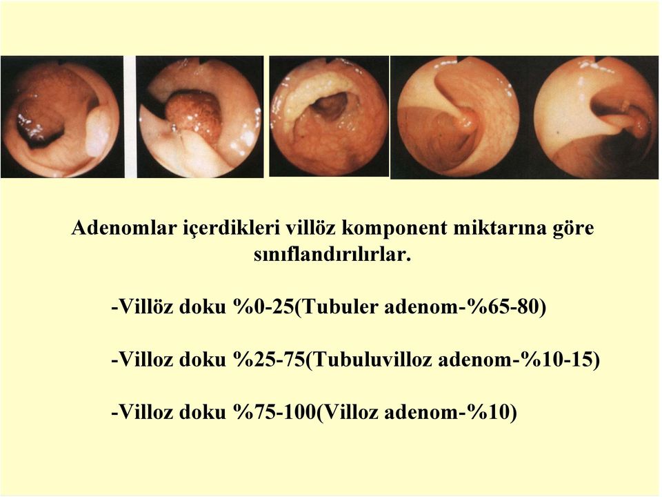 -Villöz doku %0-25(Tubuler adenom-%65-80) -Villoz