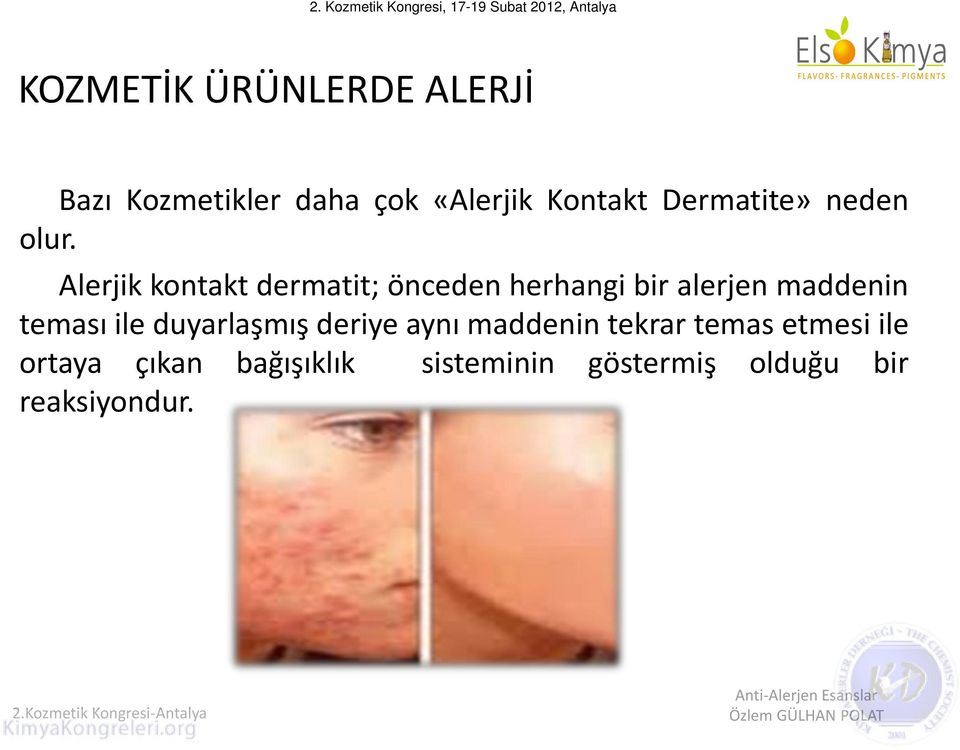 Alerjik kontakt dermatit; önceden herhangi bir alerjen maddenin teması
