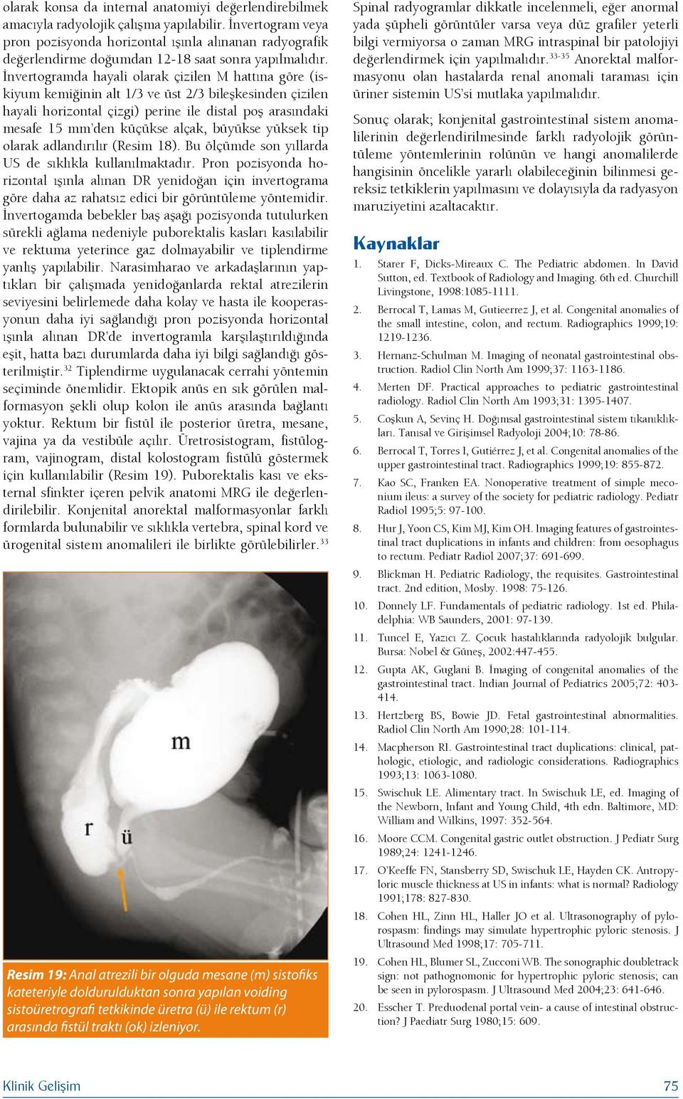 İnvertogramda hayali olarak çizilen M hattına göre (iskiyum kemiğinin alt 1/3 ve üst 2/3 bileşkesinden çizilen hayali horizontal çizgi) perine ile distal poş arasındaki mesafe 15 mm den küçükse