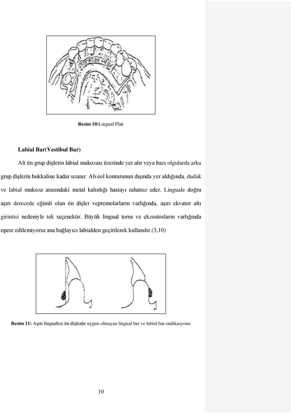 Linguale doğru aşırı derecede eğimli olan ön dişler vepremolarların varlığında, aşırı ekvator altı girintisi nedeniyle tek seçenektir.