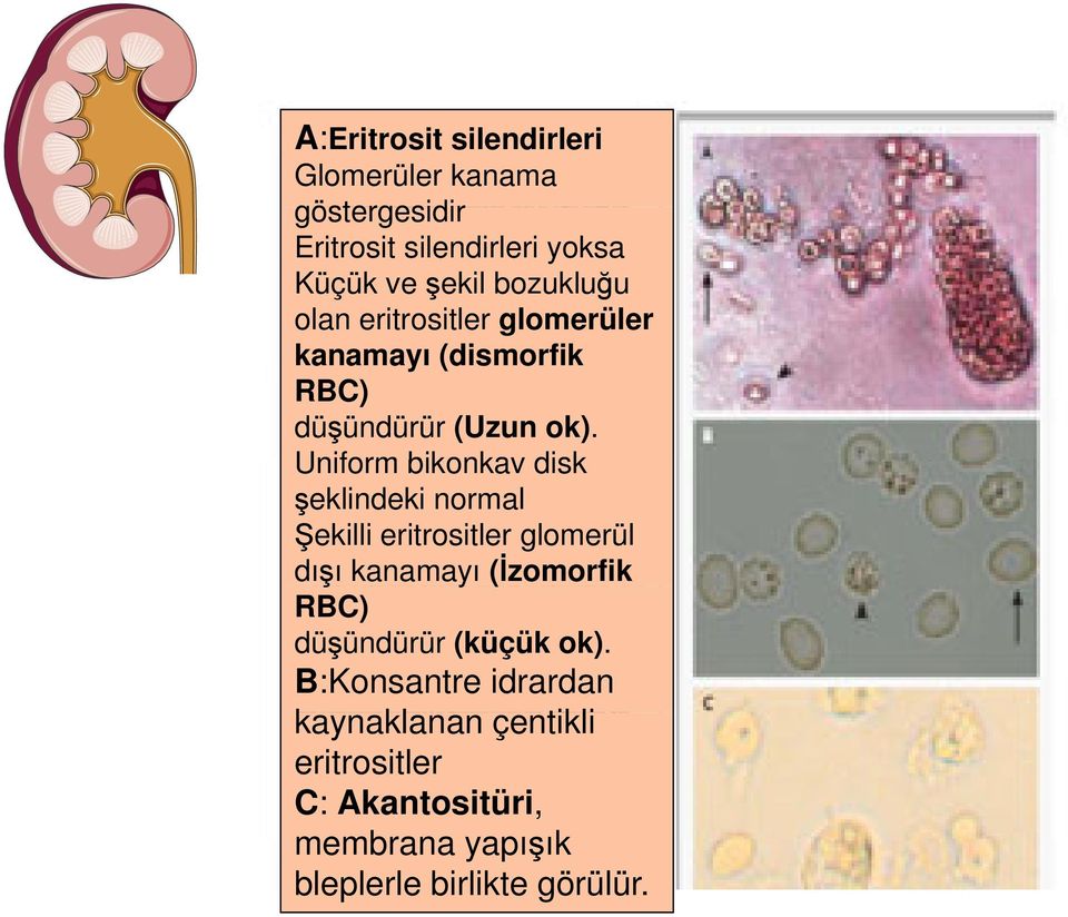 Uniform bikonkav disk şeklindeki normal Şekilli eritrositler glomerül dışı ş kanamayı (İzomorfik RBC)