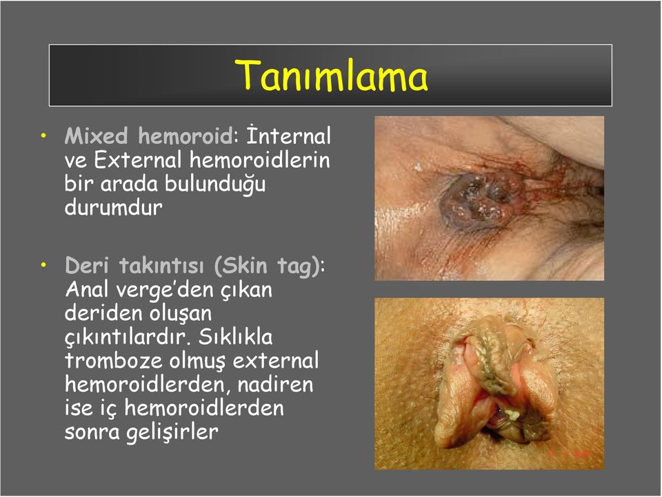 den çıkan deriden oluşan çıkıntılardır.