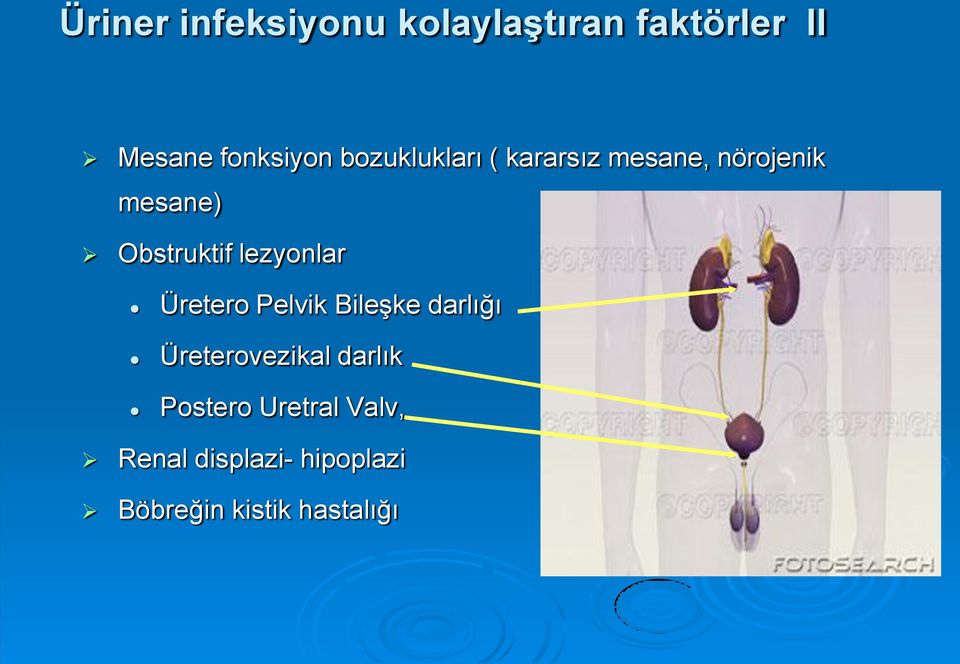 lezyonlar Üretero Pelvik Bileşke darlığı Üreterovezikal darlık