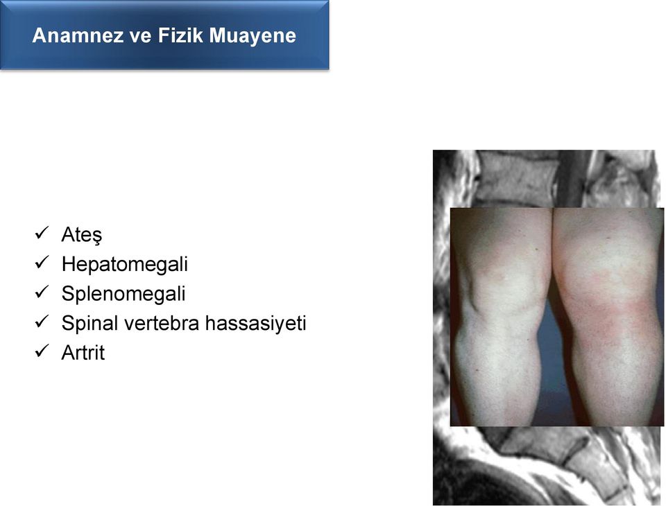 Hepatomegali