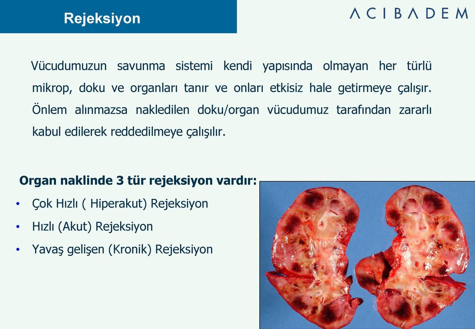 Önlem alınmazsa nakledilen doku/organ vücudumuz tarafından zararlı kabul edilerek reddedilmeye