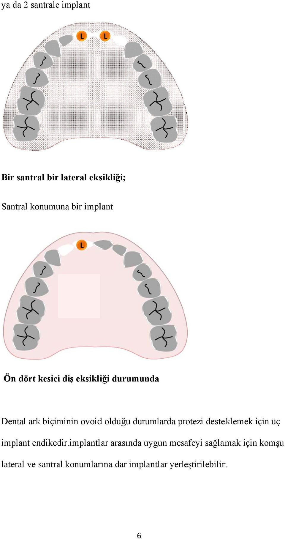 durumlarda protezi desteklemek için üç implant endikedir.