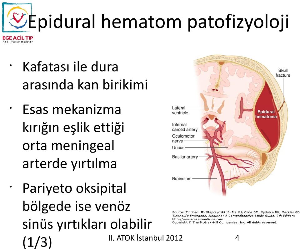 meningeal arterde yırtılma Pariyeto oksipital bölgede ise