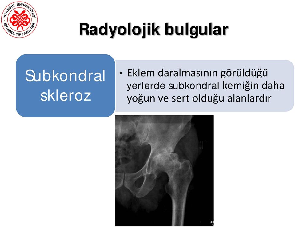 görüldüğü yerlerde subkondral