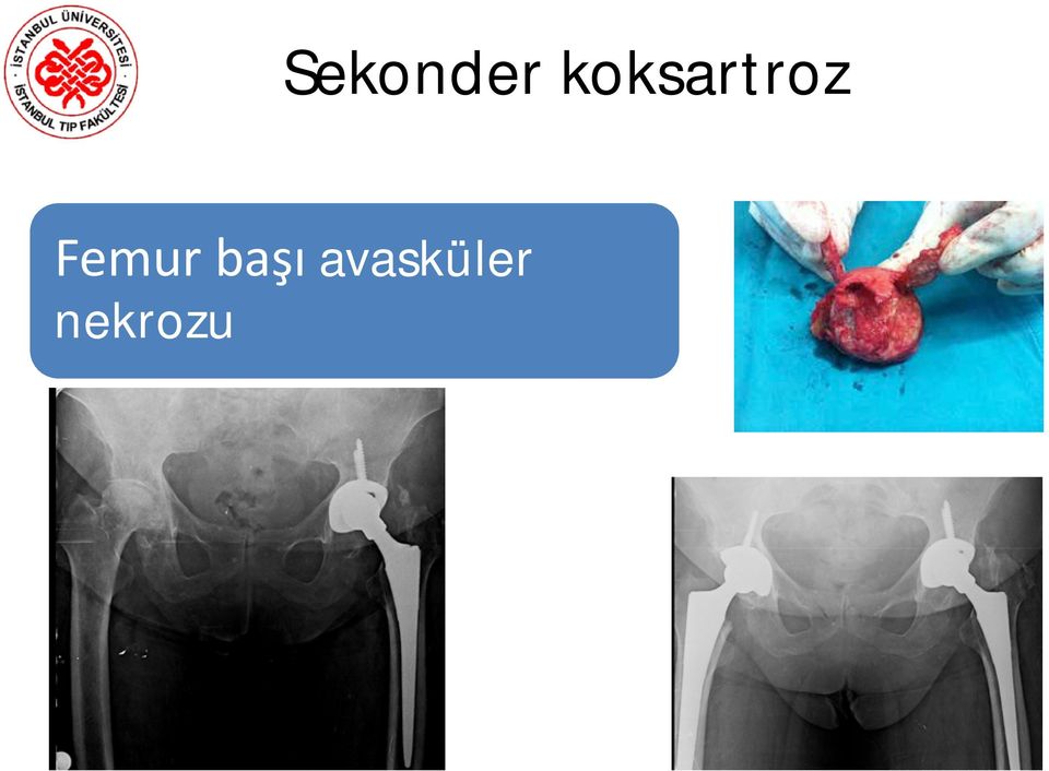 Femur başı