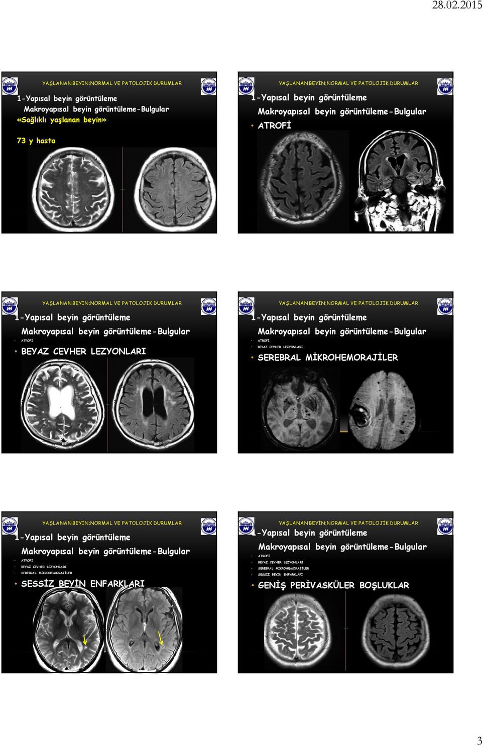 LEZYONLARI SEREBRAL MİKROHEMORAJİLER SESSİZ BEYİN ENFARKLARI ATROFİ BEYAZ CEVHER