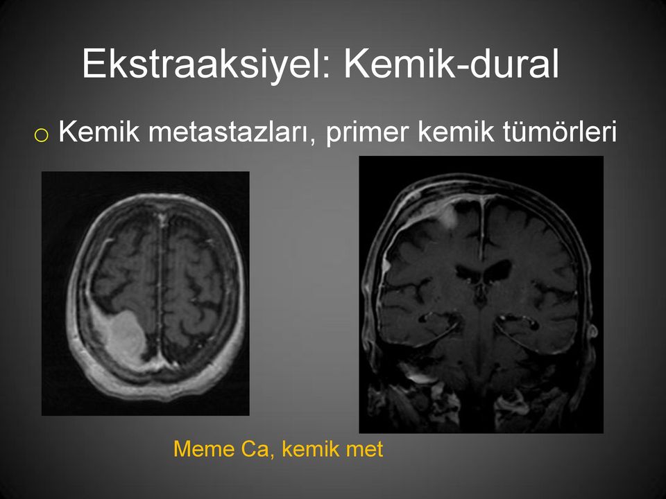 metastazları, primer