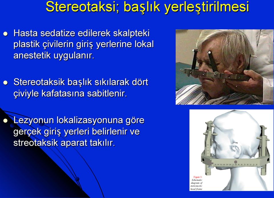 Stereotaksik başlık sıkılarak dört çiviyle kafatasına sabitlenir.