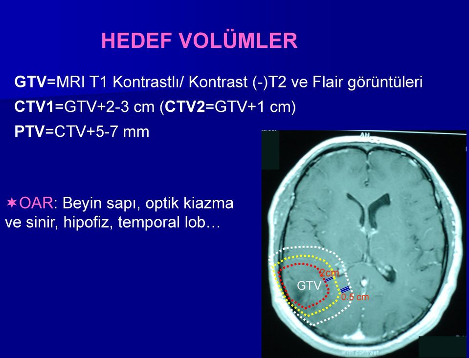 (CTV2=GTV+1 cm) PTV=CTV+5-7 mm OAR: Beyin sapı,