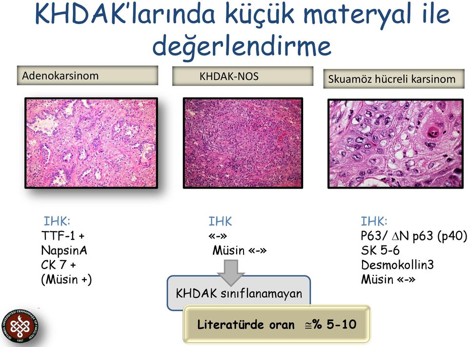 + (Müsin +) IHK «-» Müsin «-» KHDAK sınıflanamayan IHK: P63/