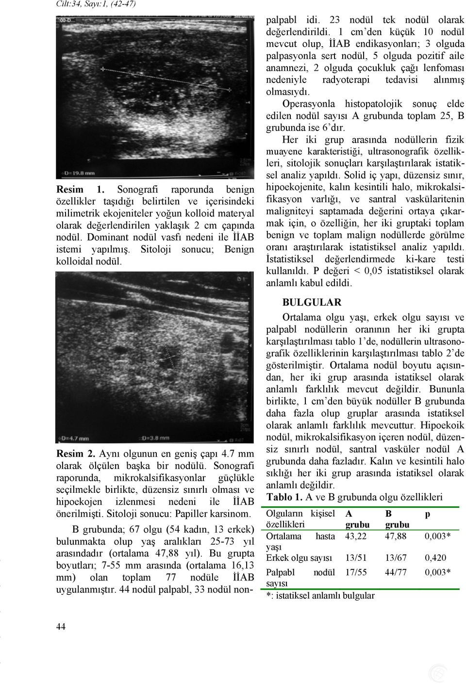 Dominant nodül vasfı nedeni ile İİAB istemi yapılmış. Sitoloji sonucu; Benign kolloidal nodül. Resim 2. Aynı olgunun en geniş çapı 4.7 mm olarak ölçülen başka bir nodülü.