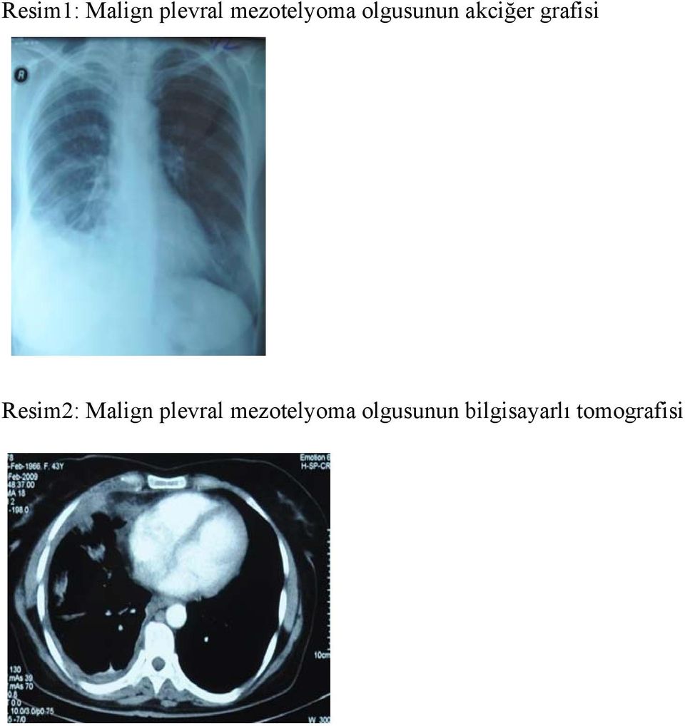 grafisi Resim2: Malign plevral
