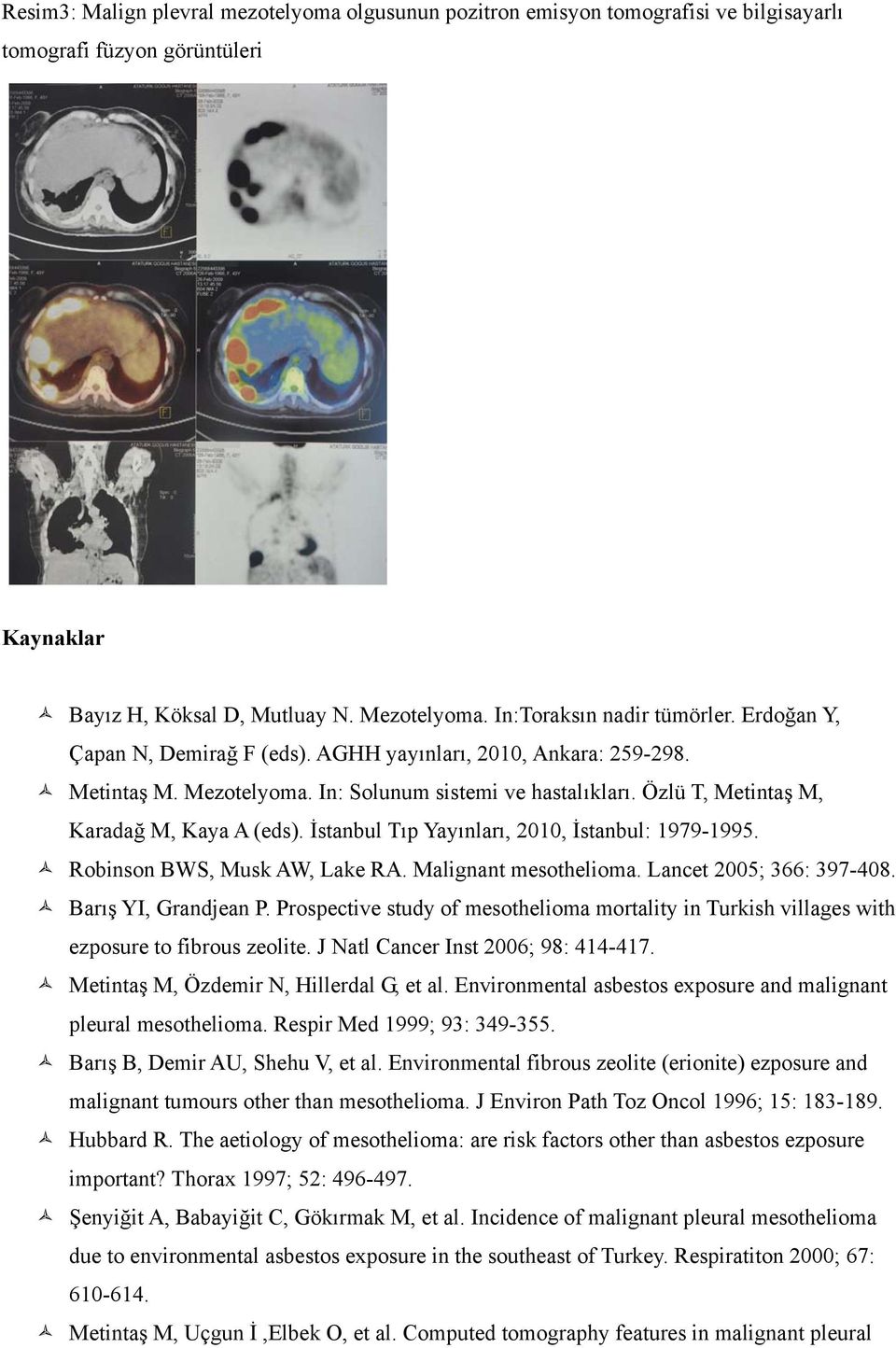 İstanbul Tıp Yayınları, 2010, İstanbul: 1979-1995. Robinson BWS, Musk AW, Lake RA. Malignant mesothelioma. Lancet 2005; 366: 397-408. Barış YI, Grandjean P.