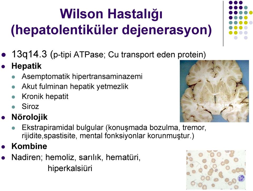 fulminan hepatik yetmezlik Kronik hepatit Siroz Nörolojik Ekstrapiramidal bulgular