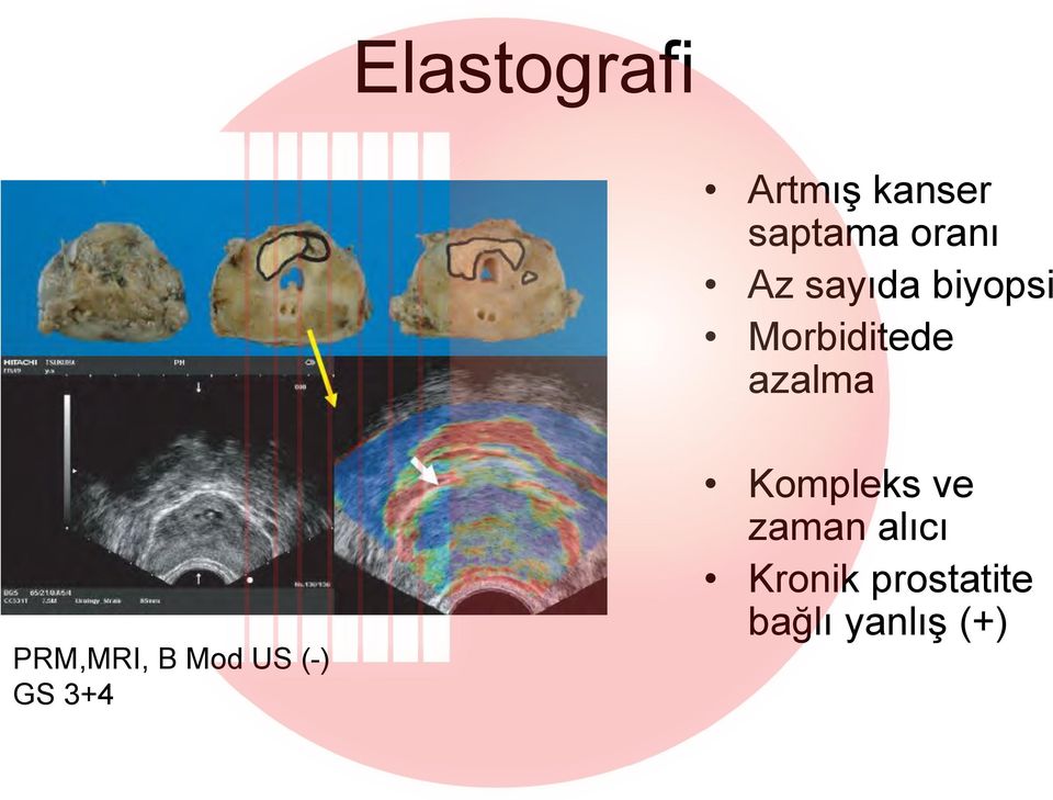 PRM,MRI, B Mod US (-) GS 3+4 Kompleks ve