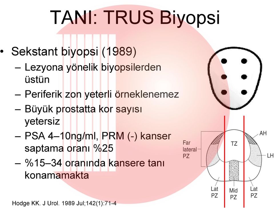 prostatta kor sayısı yetersiz PSA 4 10ng/ml, PRM (-) kanser saptama