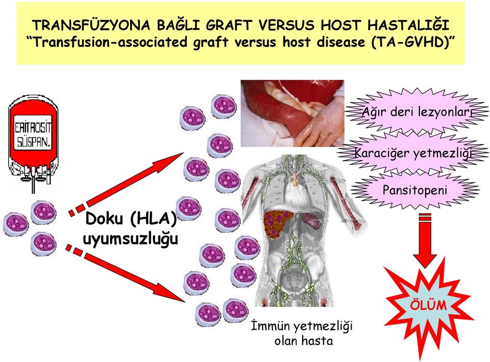 (TA-GVHD) Ağır deri lezyonları Karaciğer yetmezliği