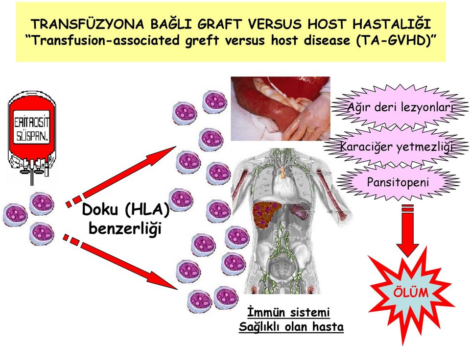 (TA-GVHD) Ağır deri lezyonları Karaciğer yetmezliği