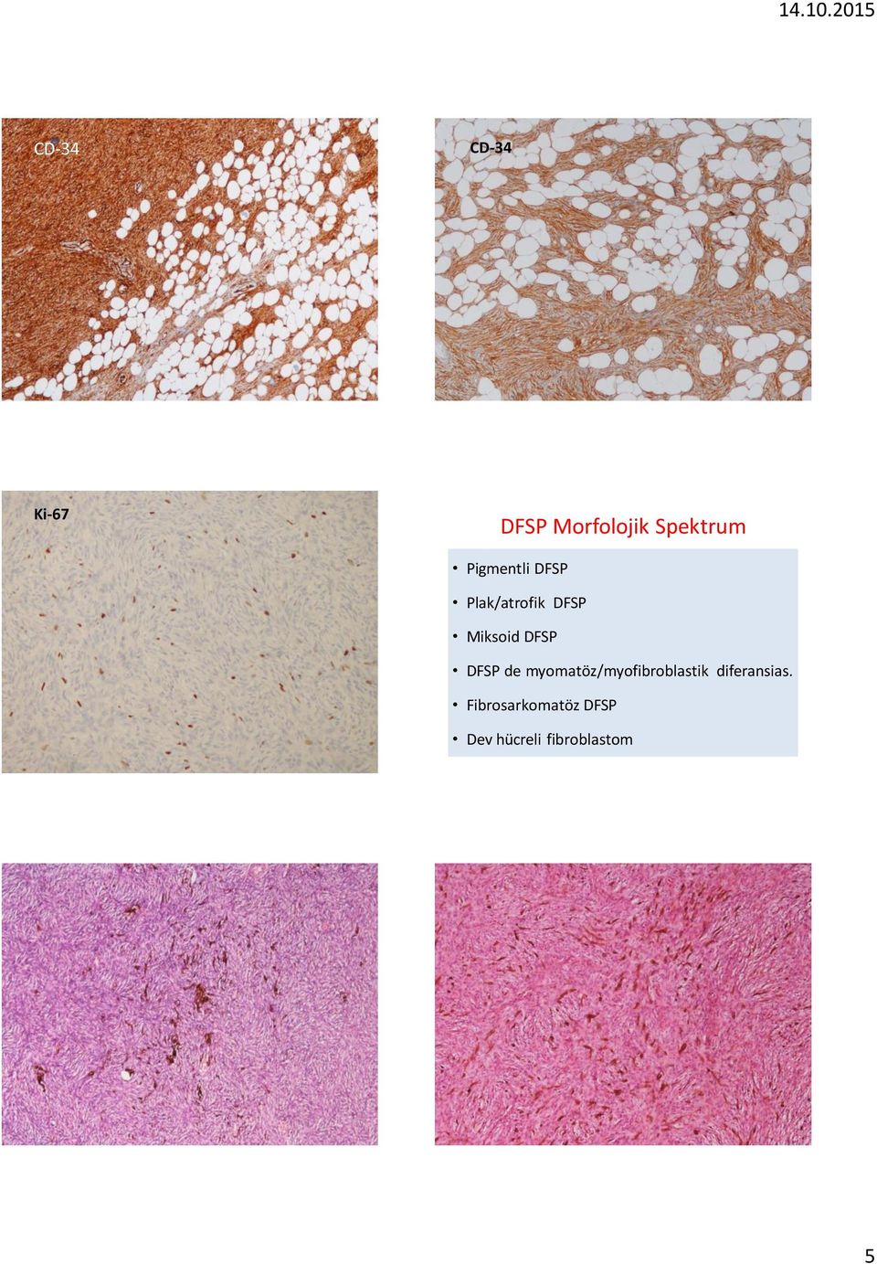 DFSP de myomatöz/myofibroblastik diferansias.