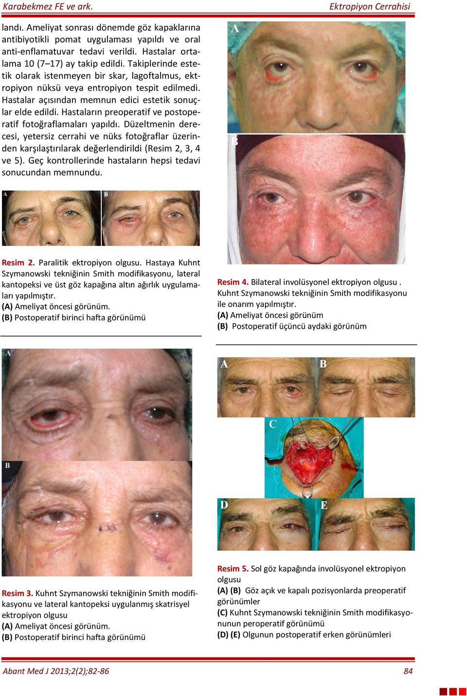 Hastaların preoperatif ve postoperatif fotoğraflamaları yapıldı. Düzeltmenin derecesi, yetersiz cerrahi ve nüks fotoğraflar üzerinden karşılaştırılarak değerlendirildi (Resim 2, 3, 4 ve 5).