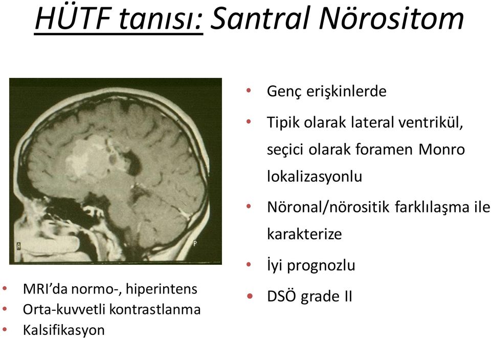 Nöronal/nörositik farklılaşma ile karakterize MRI da normo-,
