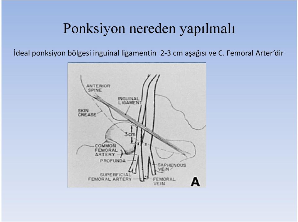 inguinal ligamentin 2 3 cm