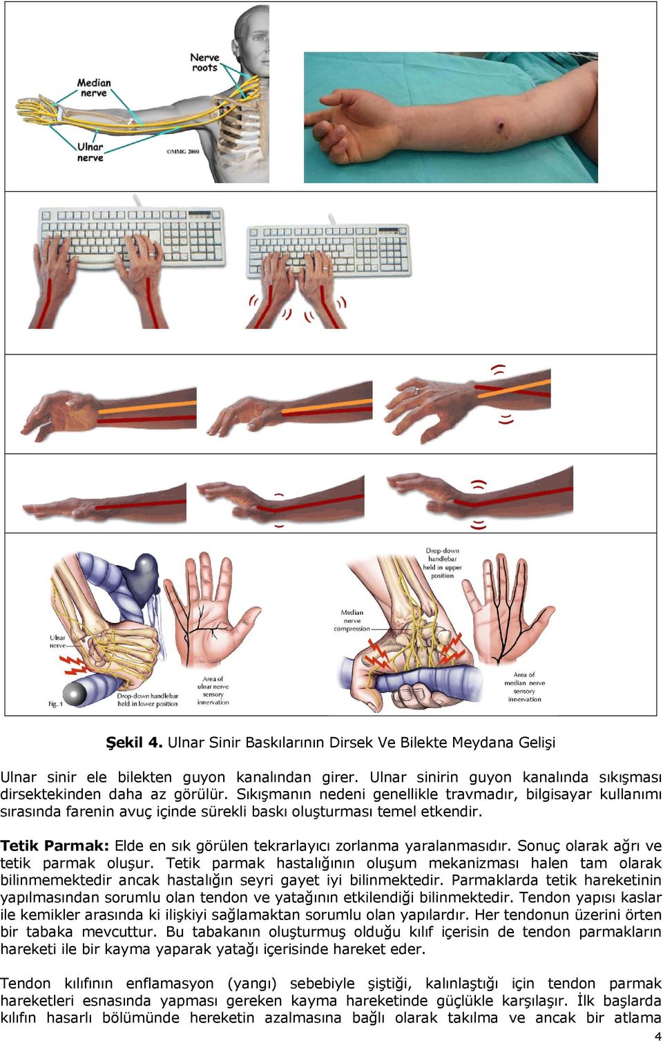Tetik Parmak: Elde en sık görülen tekrarlayıcı zorlanma yaralanmasıdır. Sonuç olarak ağrı ve tetik parmak oluşur.