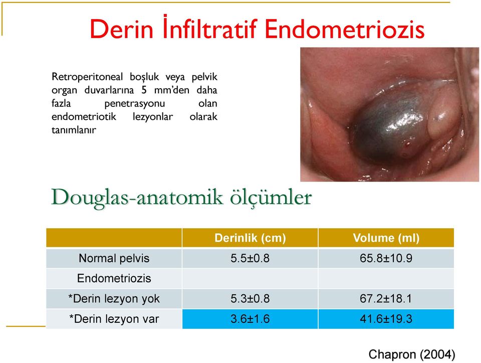 Douglas-anatomik ölçümler Derinlik (cm) Volume (ml) Normal pelvis 5.5±0.8 65.8±10.