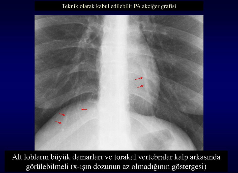 torakal vertebralar kalp arkasında