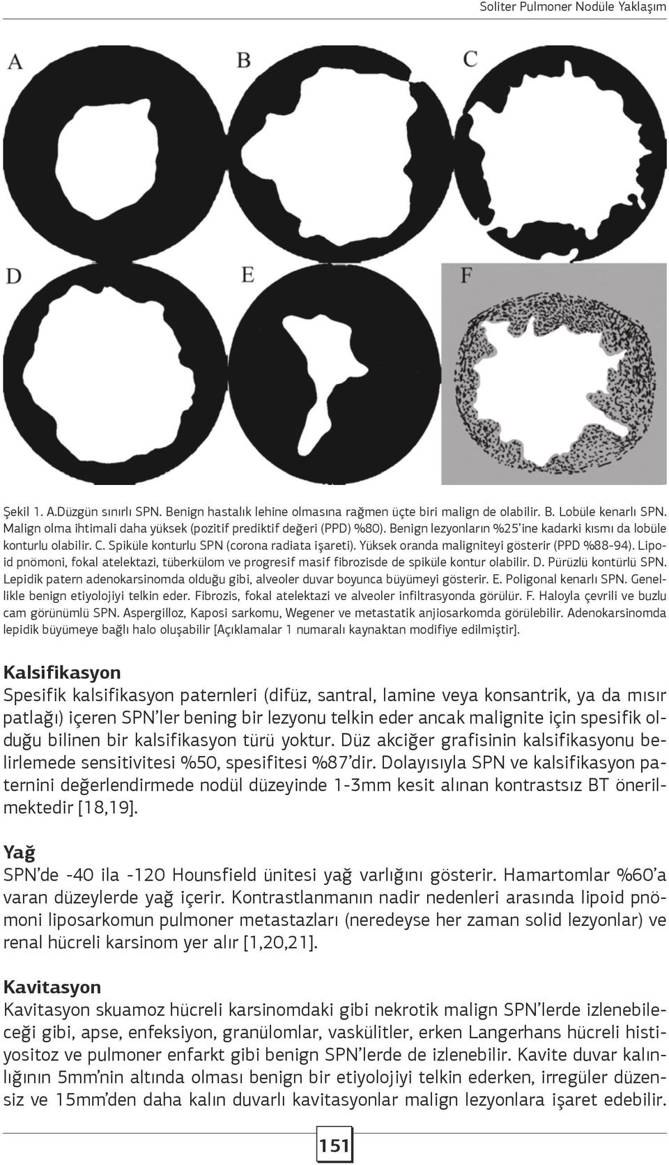 Lipoid pnömoni, fokal atelektazi, tüberkülom ve progresif masif fibrozisde de spiküle kontur olabilir. D. Pürüzlü kontürlü SPN.