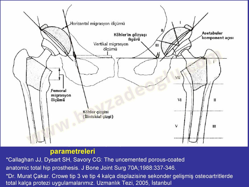 J Bone Joint Surg 70A;1988:337-346. *Dr. Murat Çakar.