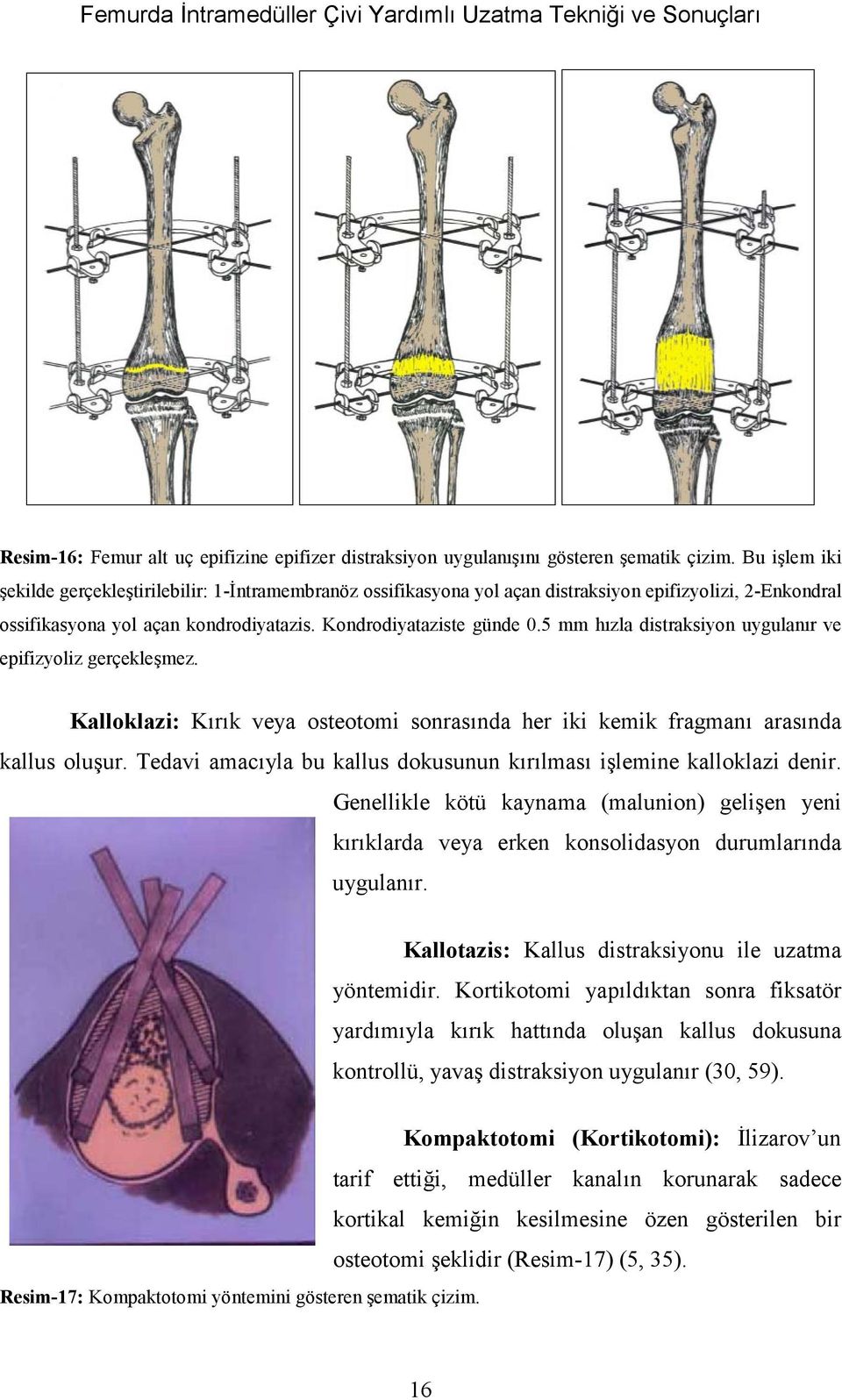 5 mm hùzla distraksiyon uygulanùr ve epifizyoliz gerçekleşmez. Kalloklazi: KÙrÙk veya osteotomi sonrasùnda her iki kemik fragmanù arasùnda kallus oluşur.