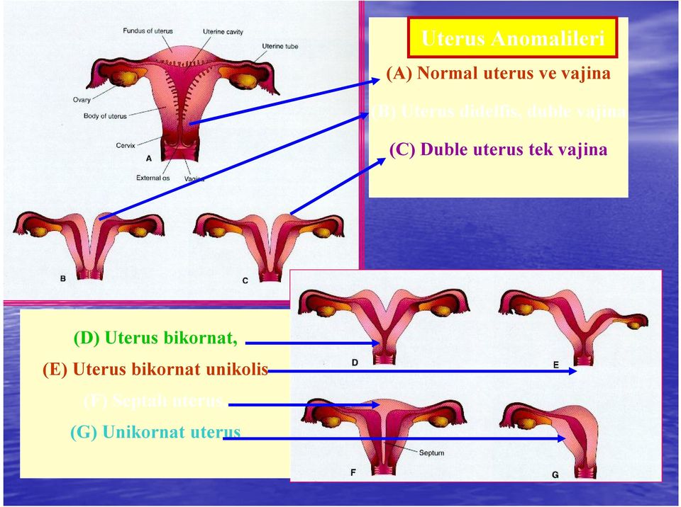 uterus tek vajina (D) Uterus bikornat, (E) Uterus