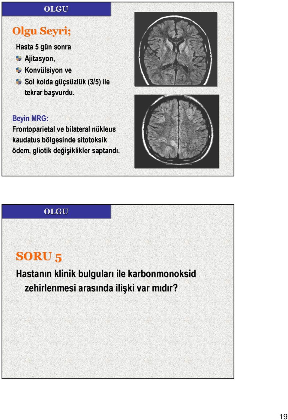 Beyin MRG: Frontoparietal ve bilateral nükleus kaudatus bölgesinde sitotoksik