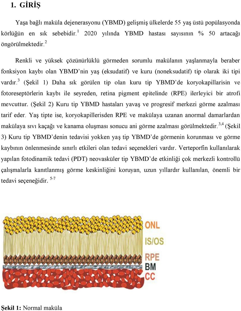 3 (ġekil 1) Daha sık görülen tip olan kuru tip YBMD de koryokapillarisin ve fotoreseptörlerin kaybı ile seyreden, retina pigment epitelinde (RPE) ilerleyici bir atrofi mevcuttur.