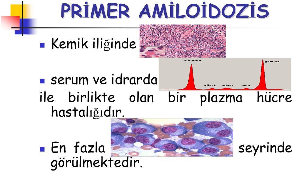 gamopati ile birlikte olan bir plazma hücre