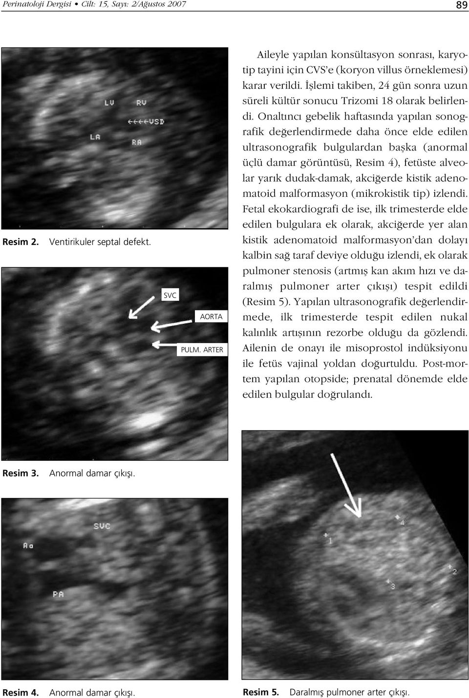 Onaltıncı gebelik haftasında yapılan sonografik de erlendirmede daha önce elde edilen ultrasonografik bulgulardan baflka (anormal üçlü damar görüntüsü, Resim 4), fetüste alveolar yarık dudak-damak,