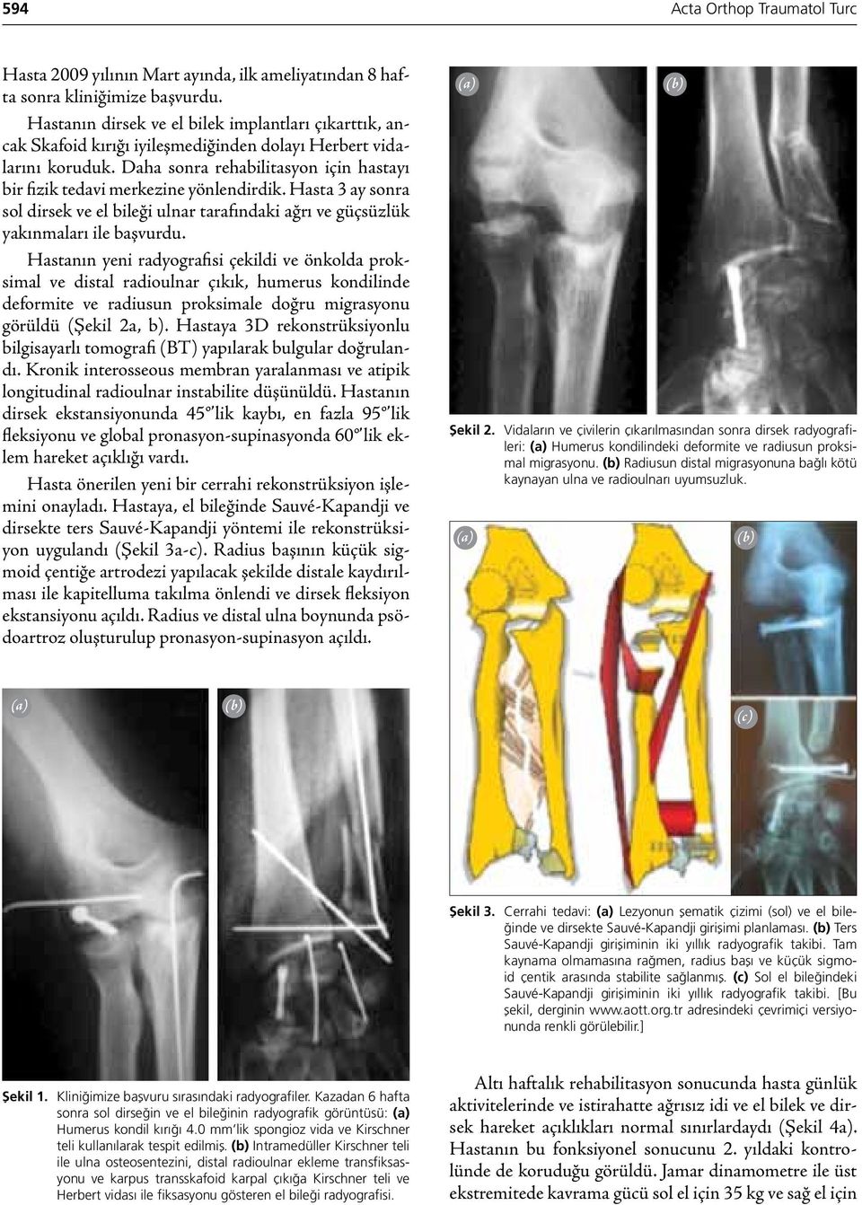 Daha sonra rehabilitasyon için hastayı bir fizik tedavi merkezine yönlendirdik. Hasta 3 ay sonra sol dirsek ve el bileği ulnar tarafındaki ağrı ve güçsüzlük yakınmaları ile başvurdu.